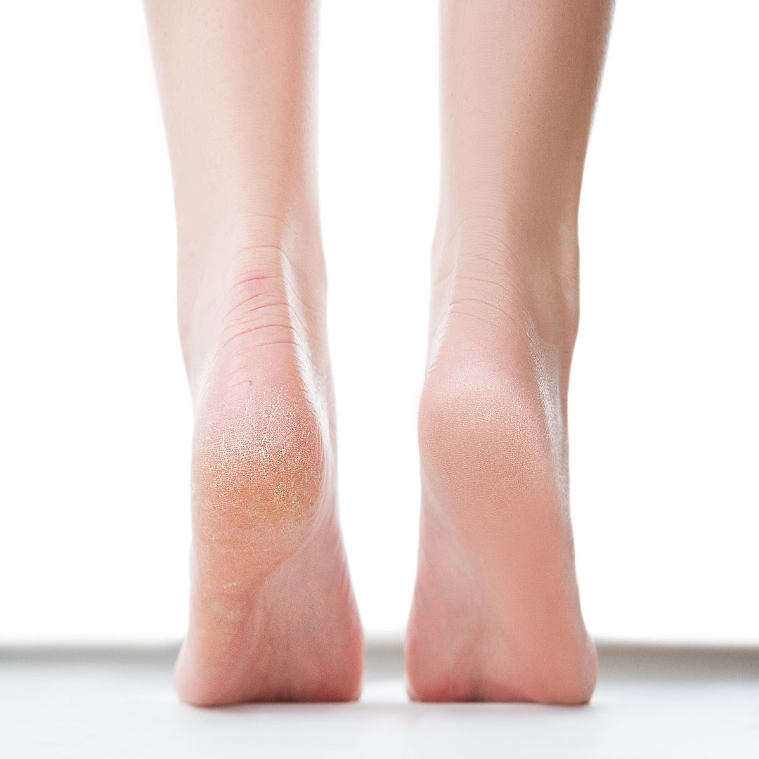 【超簡単】がさがさかかとに効果的なケアは?うるおいと温めが重要